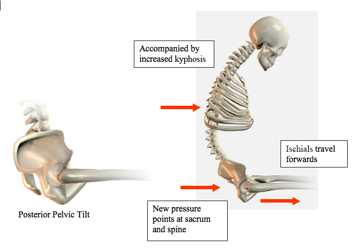 posterior pelvic tilt