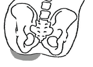 JAY Cushions: Pelvic Obliquity Management