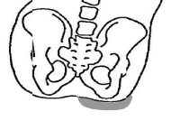 JAY Cushions: Pelvic Obliquity Management